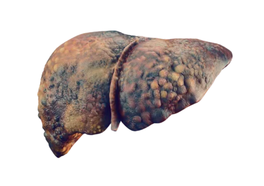 Alcoholic Liver Disease