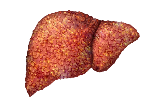 Cirrhosis