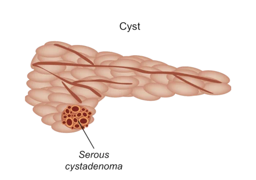 Cystic Lesions