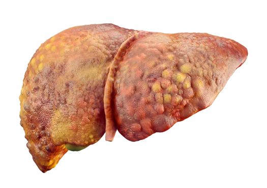 Fatty Liver Disease