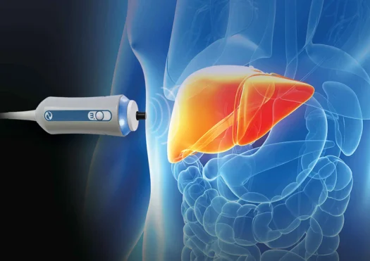 Fibroscan
