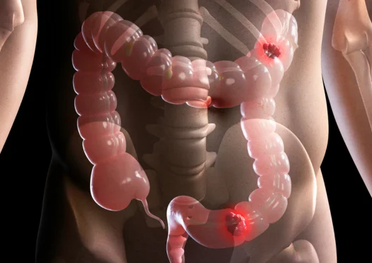 GI Cancers