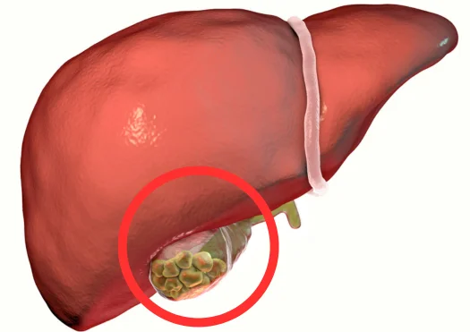 Gallstone Disease