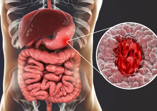 Gastritis Ulcer Diseases
