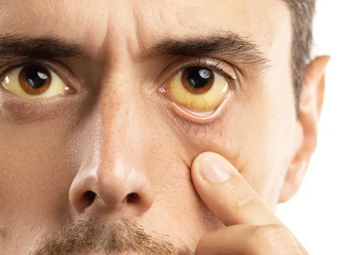 Jaundice