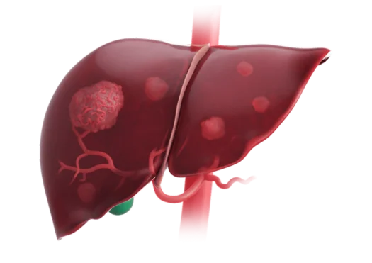 Liver Cancer HCC