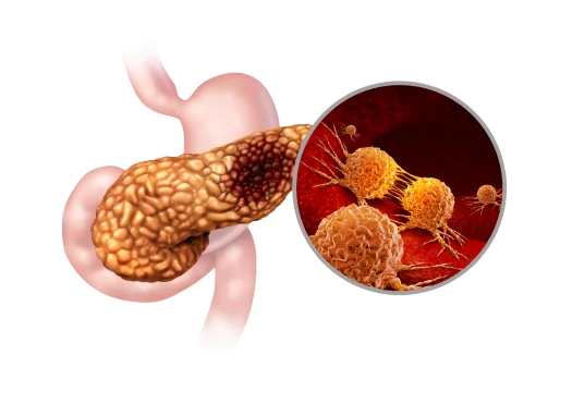 Pancreatic Cancer