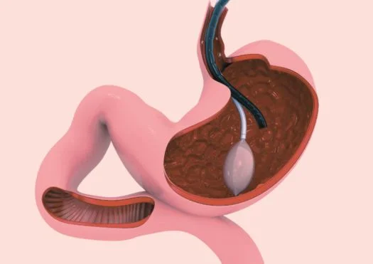endobariatrics