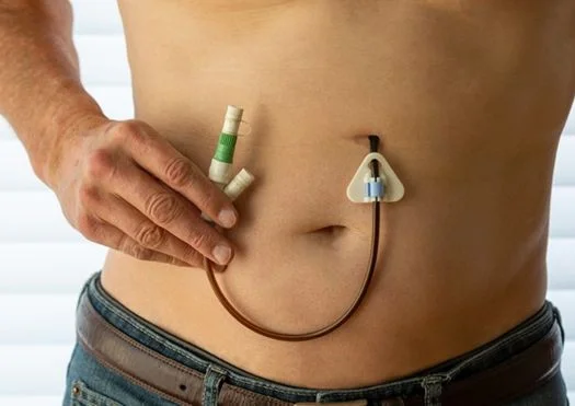 peg tube placement