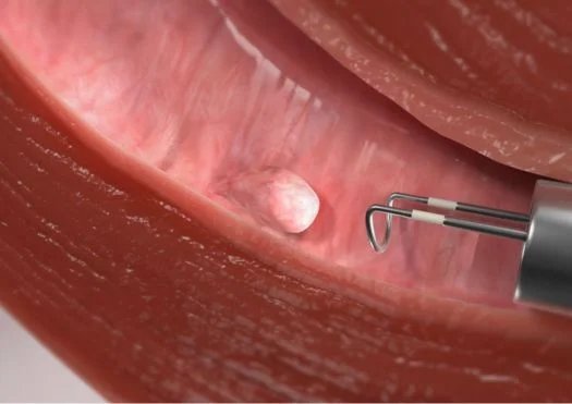polypectomy