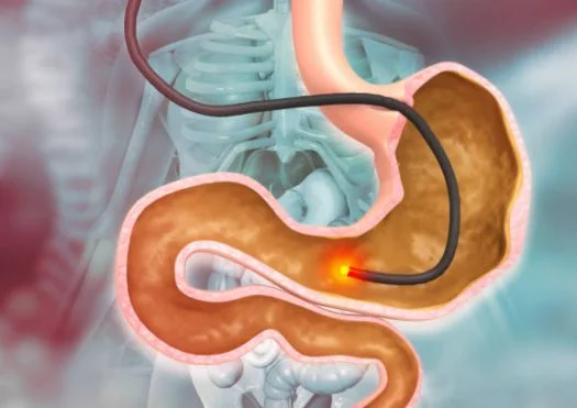 ugi endoscopy