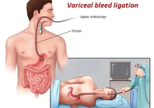 variceal banding