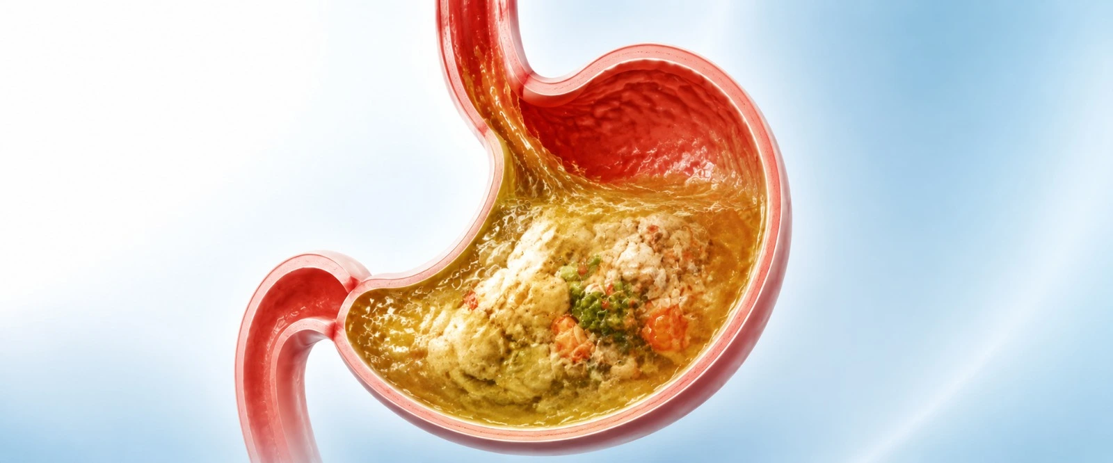 Medical diagram comparing normal gastric emptying versus gastroparesis where food sits too long in the stomach