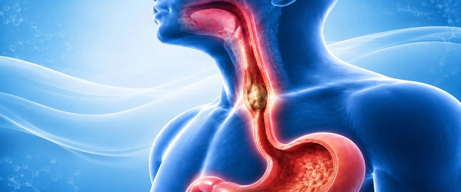 Medical diagram of lower oesophageal sphincter conditions including achalasia and dysphagia