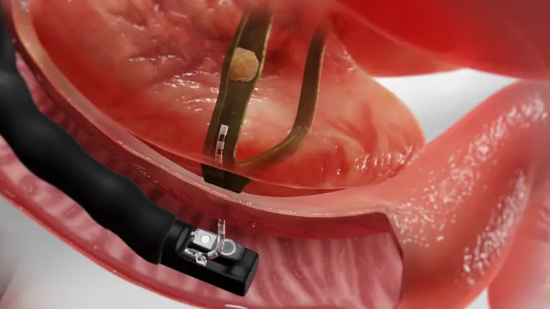 Endoscopic procedure to review and confirm ulcer healing at Gokul Gastro & Liver Care, KPHB