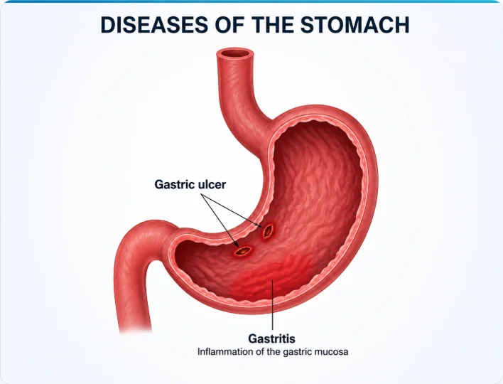 Diseases of the stomach diagram showing gastric ulcer and gastritis inflammation of the gastric mucosa