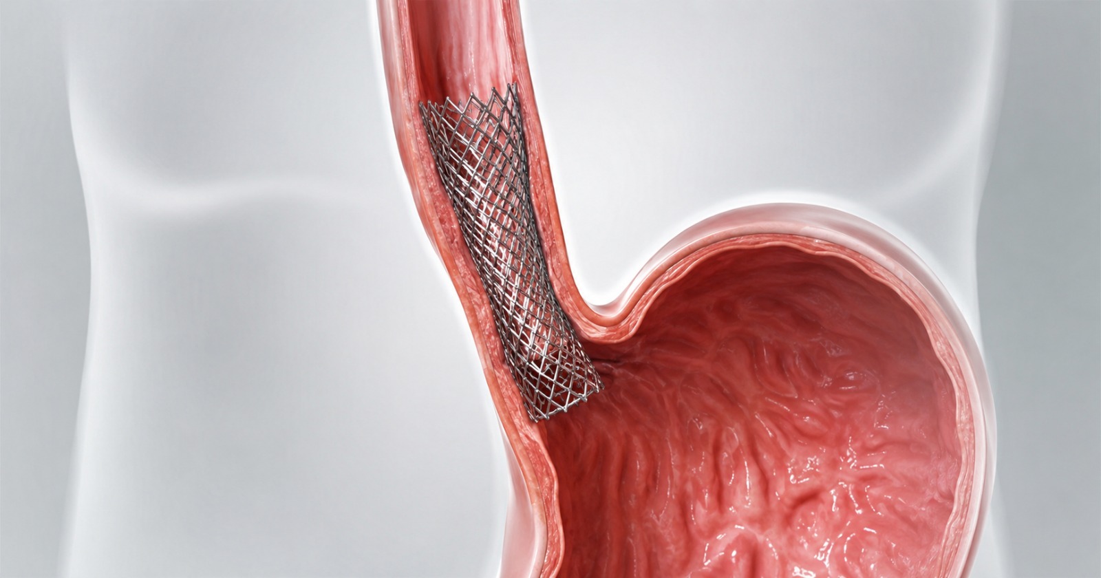 Endoscopic stenting to reopen a blocked passage