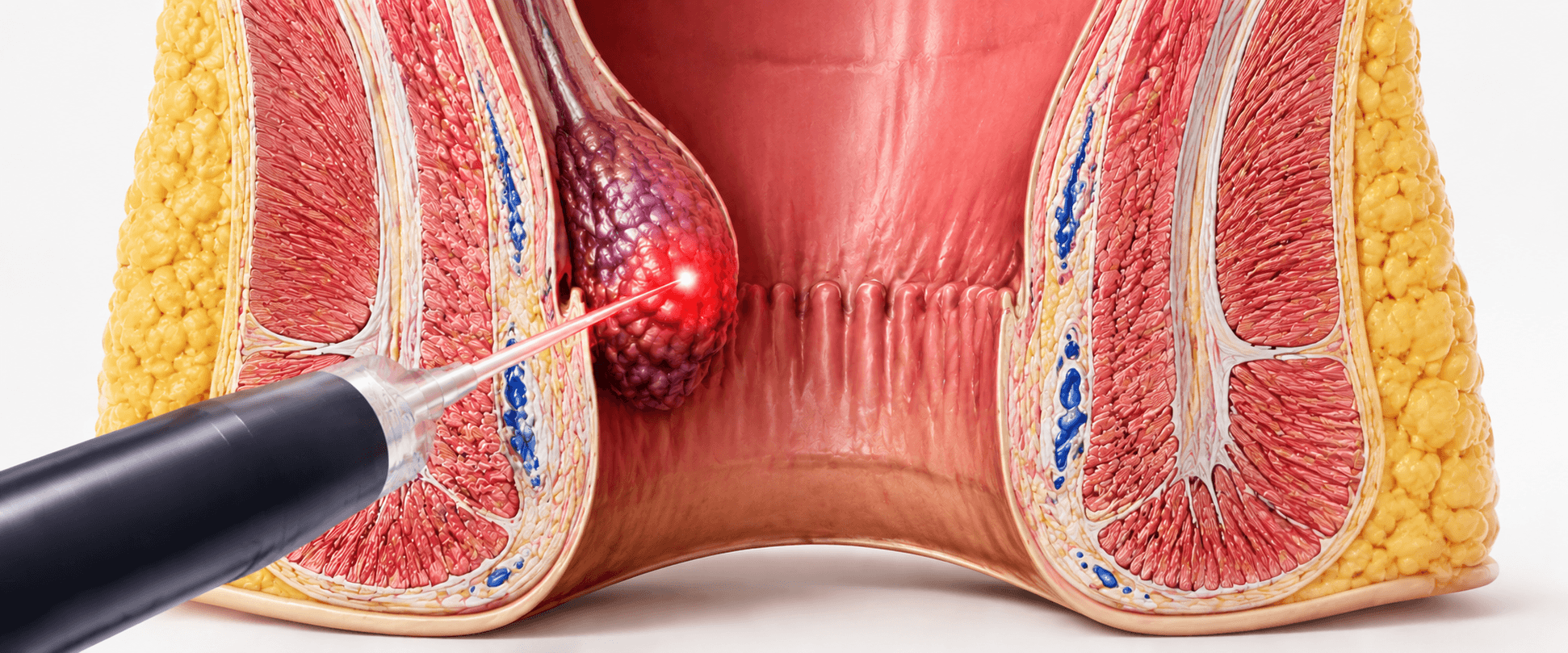 Laser haemorrhoidoplasty procedure for piles