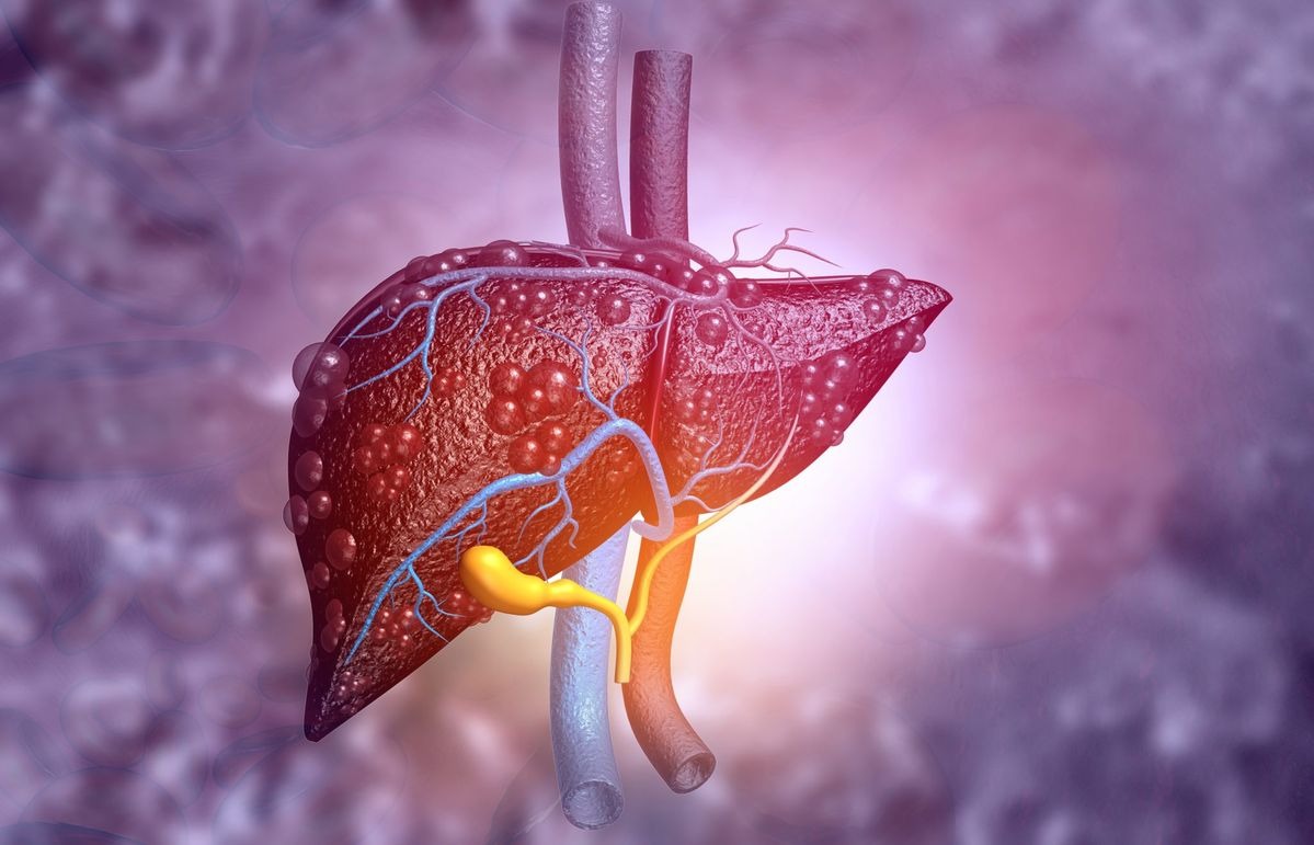 Cirrhosis assessment and treatment at Gokul Gastro & Liver Care, KPHB, Kukatpally