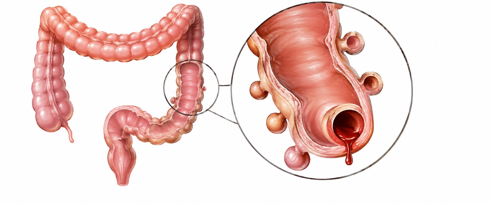 Diverticular disease, small pouches in the colon wall