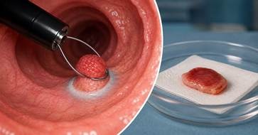 Endoscopic removal of early surface-level lesions