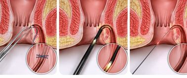 LIFT, VAAFT and laser sphincter-sparing fistula procedures