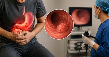 Stomach cancer treatment following H. pylori infection or gastritis